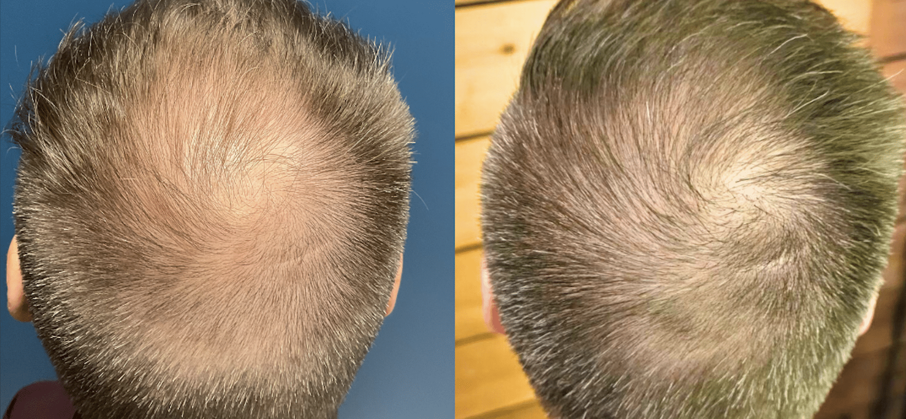 Hair growth