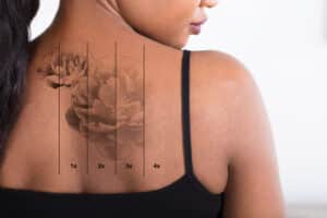 A tattoo on a woman's back fading after laser tattoo removal in Chicago