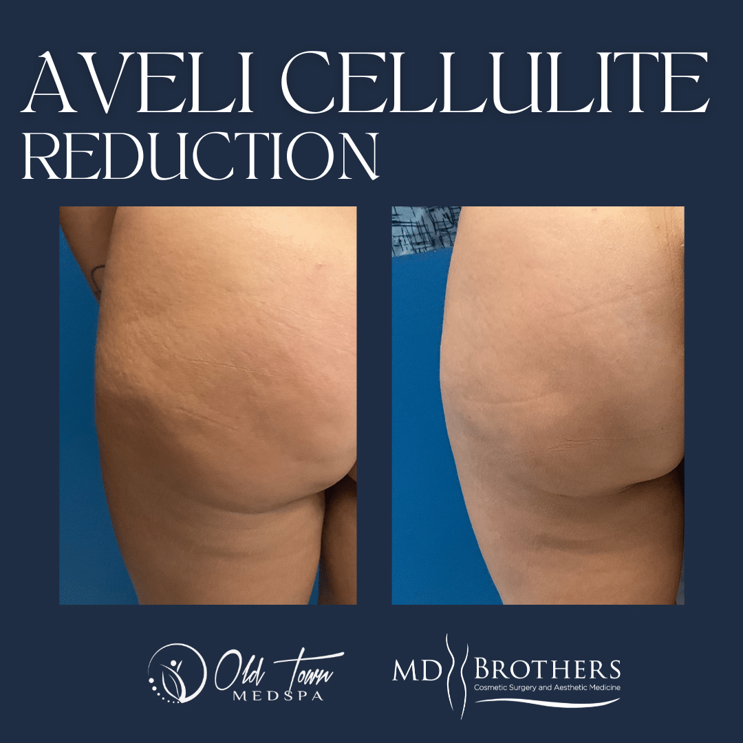 Before & After Aveli Cellulite Treatment Chicago IL