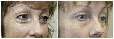 elixis elite eyes