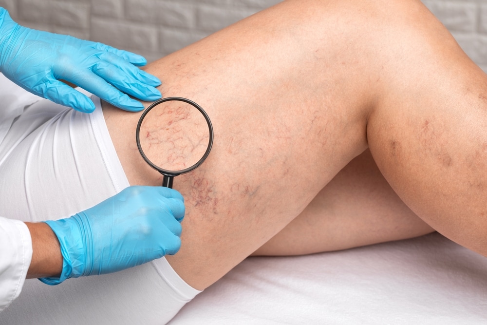 Laser Removal of Spider Veins in Chicago IL