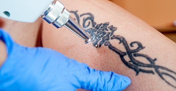 Laser tattoo removal procedure at Old Town Med Spa.