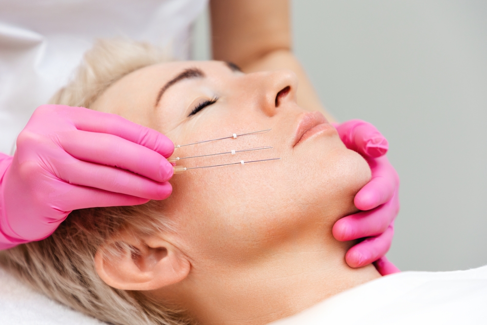 MINT thread lift procedure at Old Town Med Spa.