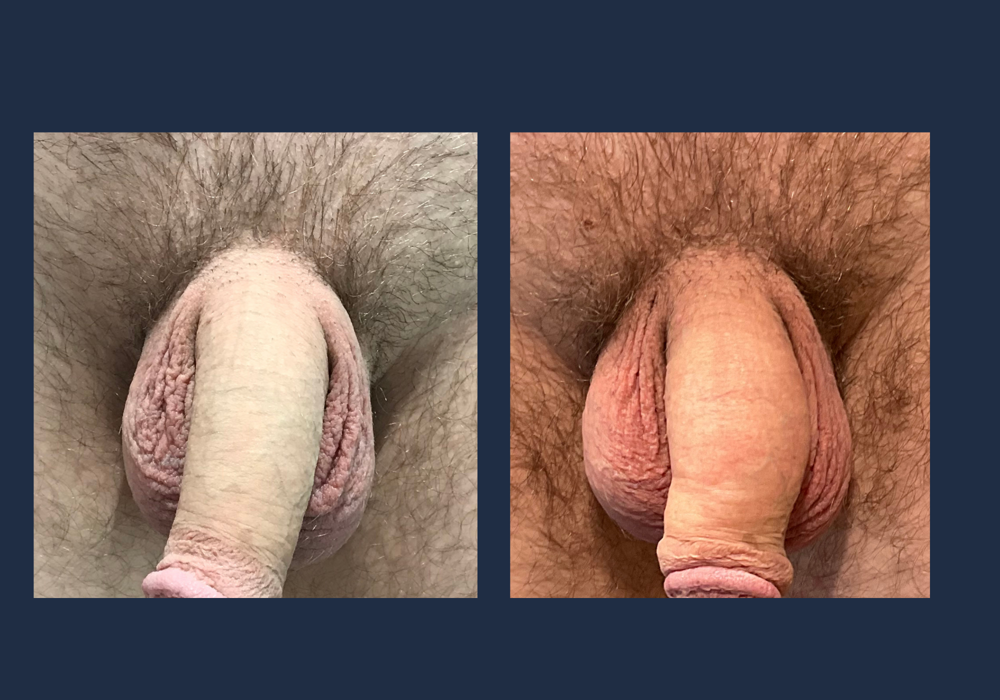 Penile Enhancement With Fillers in Chicago & Lincoln Park, IL