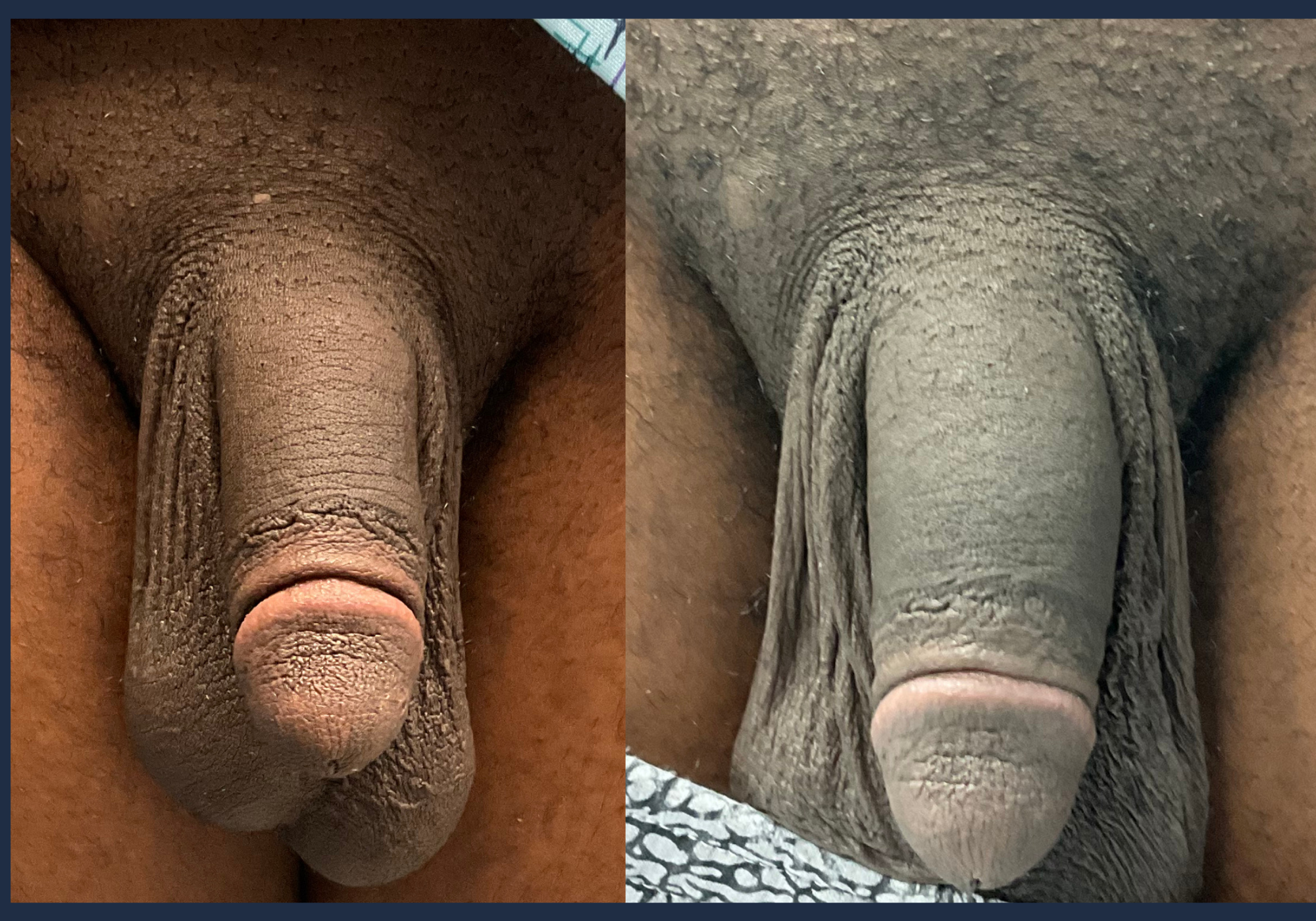 Penile Enhancement With Fillers in Chicago & Lincoln Park, IL