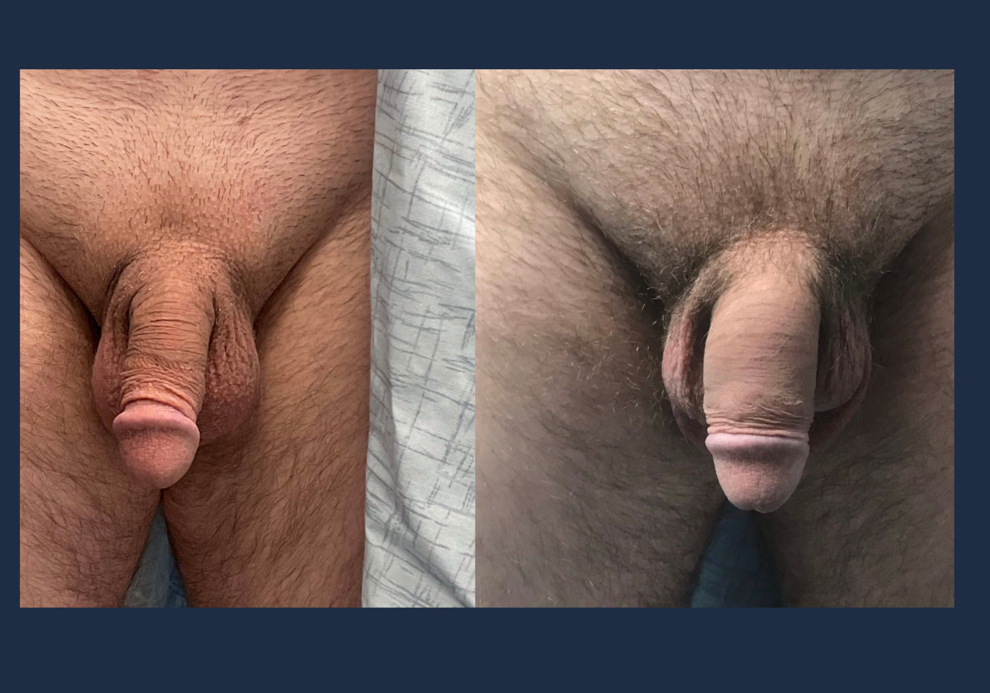 Penile Enhancement With Fillers in Chicago & Lincoln Park, IL