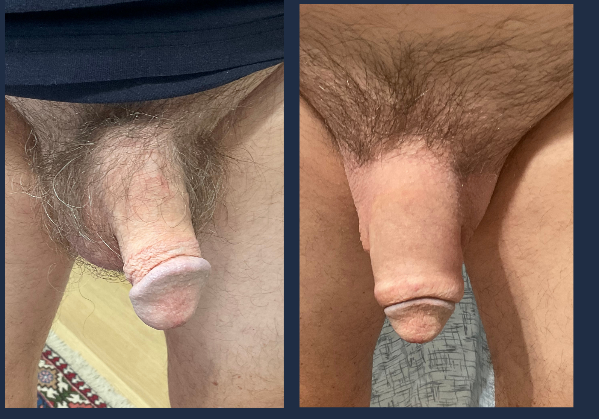 Penile Enhancement With Fillers in Chicago & Lincoln Park, IL
