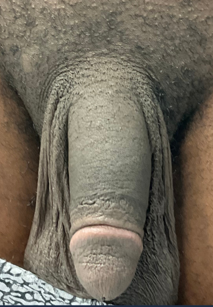 After Image: Penis Filler - front